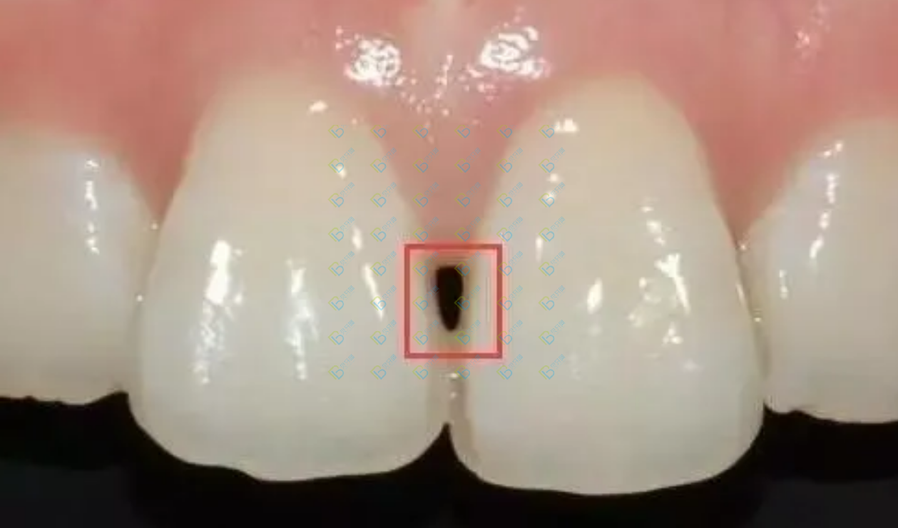 讓人聞風(fēng)喪膽的牙齒“黑三角”，比齲齒更可怕！