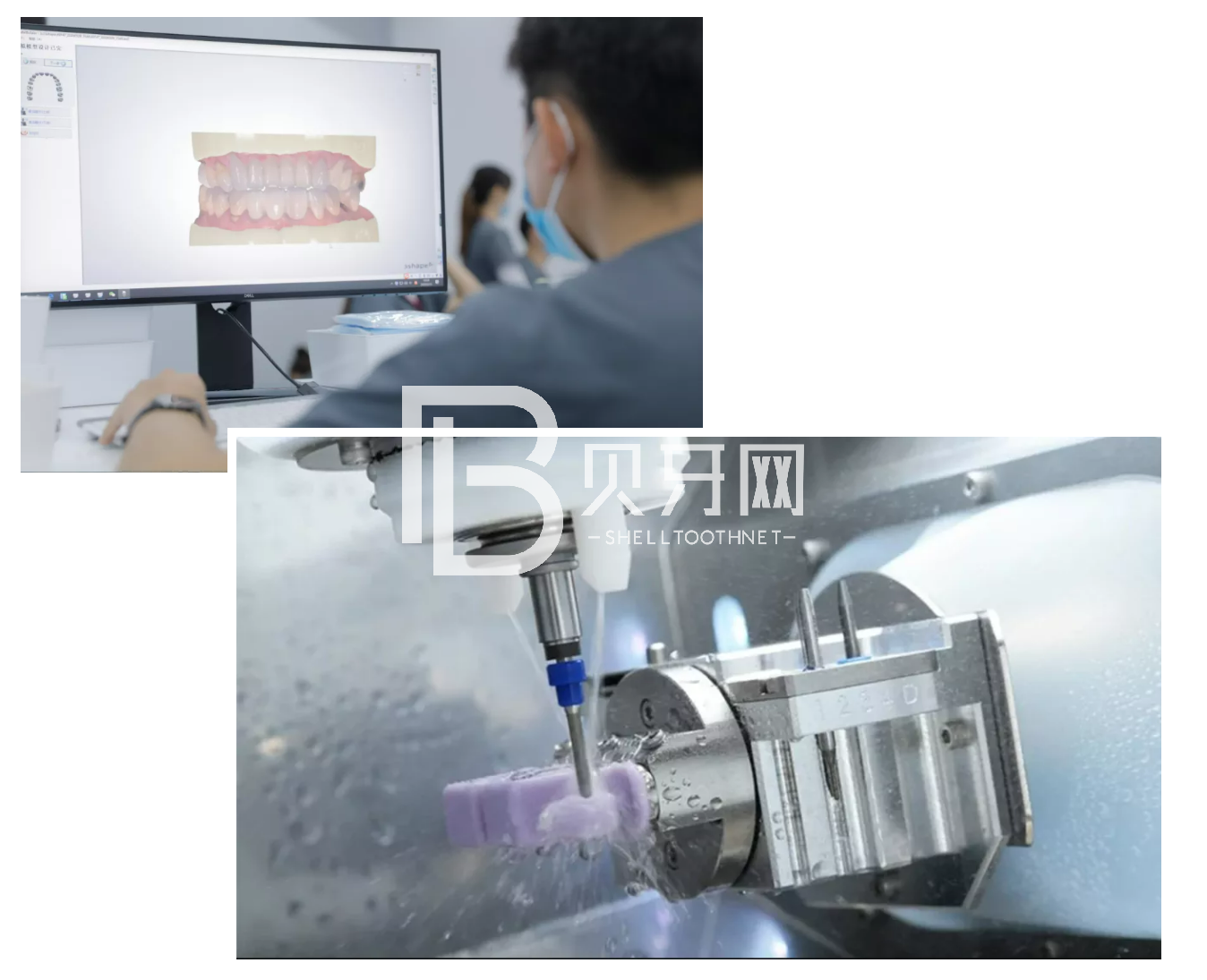 缺牙后最容易陷入的誤區(qū)，您中招了嗎？