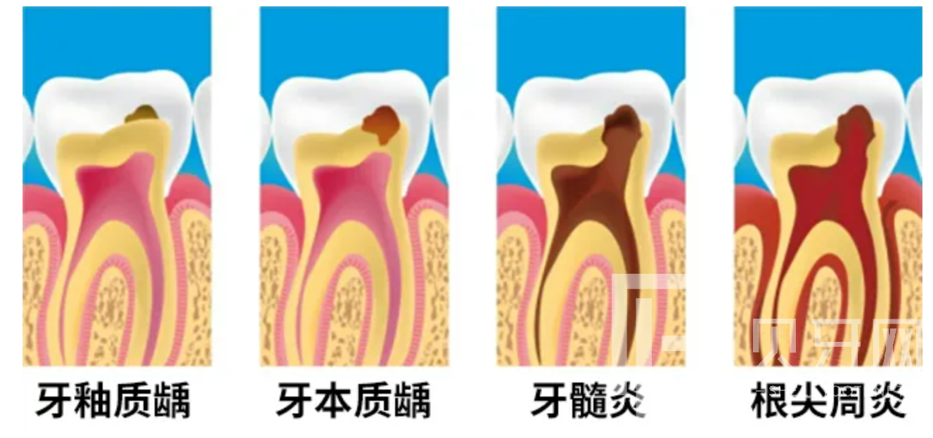 牙疼到無法入睡，我們該怎么辦？