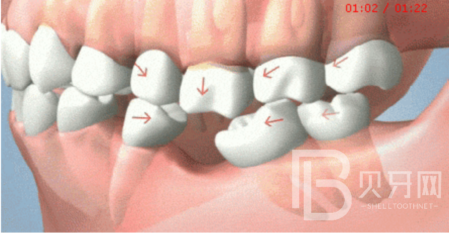 90%不知道，牙齒缺失后，盡然會(huì)出現(xiàn)這些癥狀！