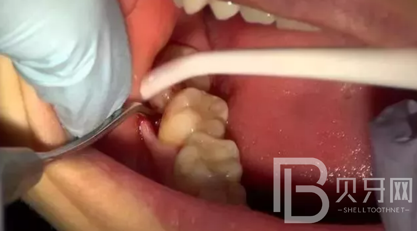 為什么牙醫(yī)建議讓拔掉智齒？