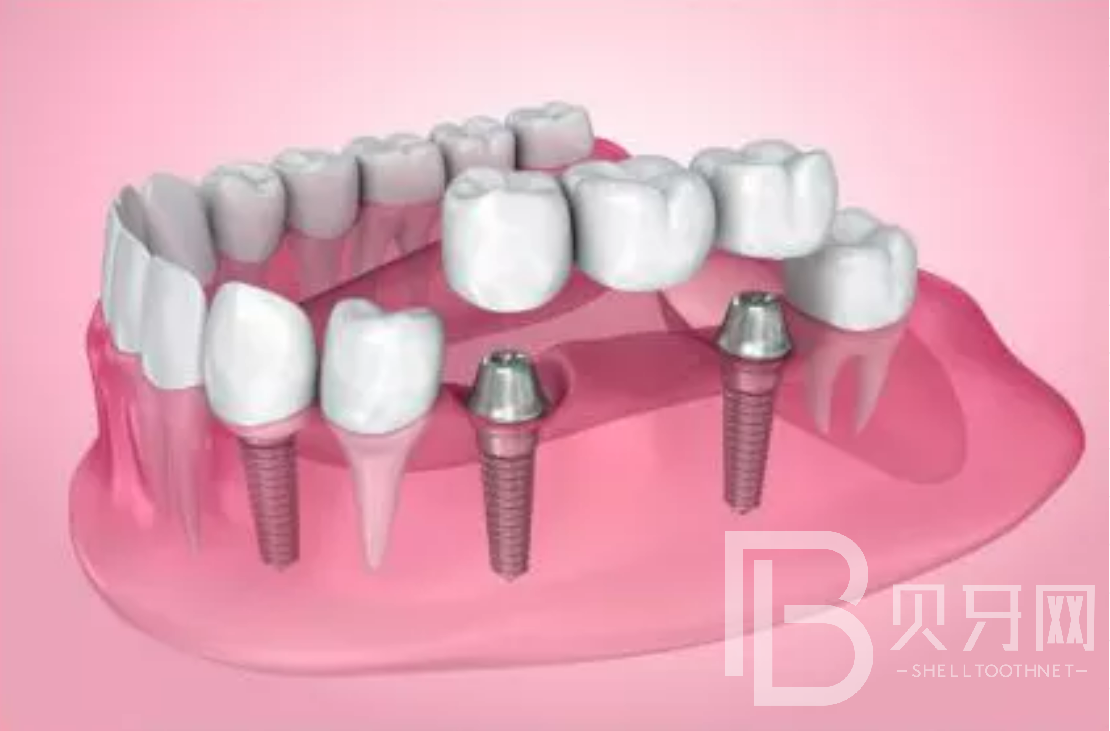 拔牙后一般多久能做種植牙？選什么植體比較好？