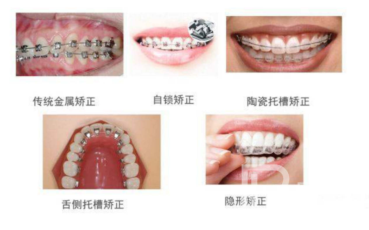 牙齒不整齊都有哪些矯正方式?分別價(jià)格多少錢？
