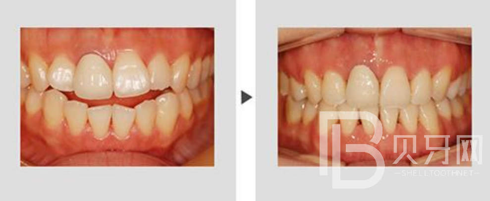 牙齒不齊一定要矯正嗎？還有哪些方式可以改變？