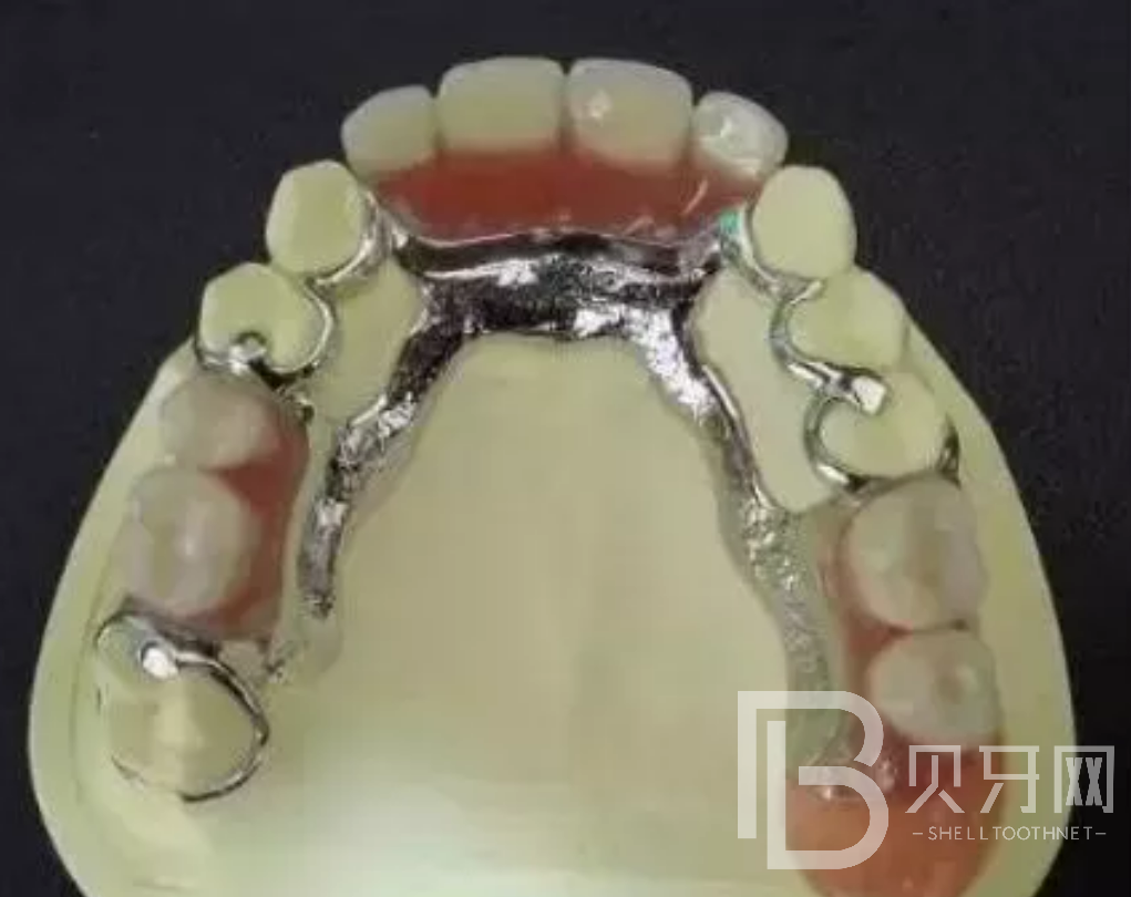 牙齒缺失一顆哪種修復方式好？