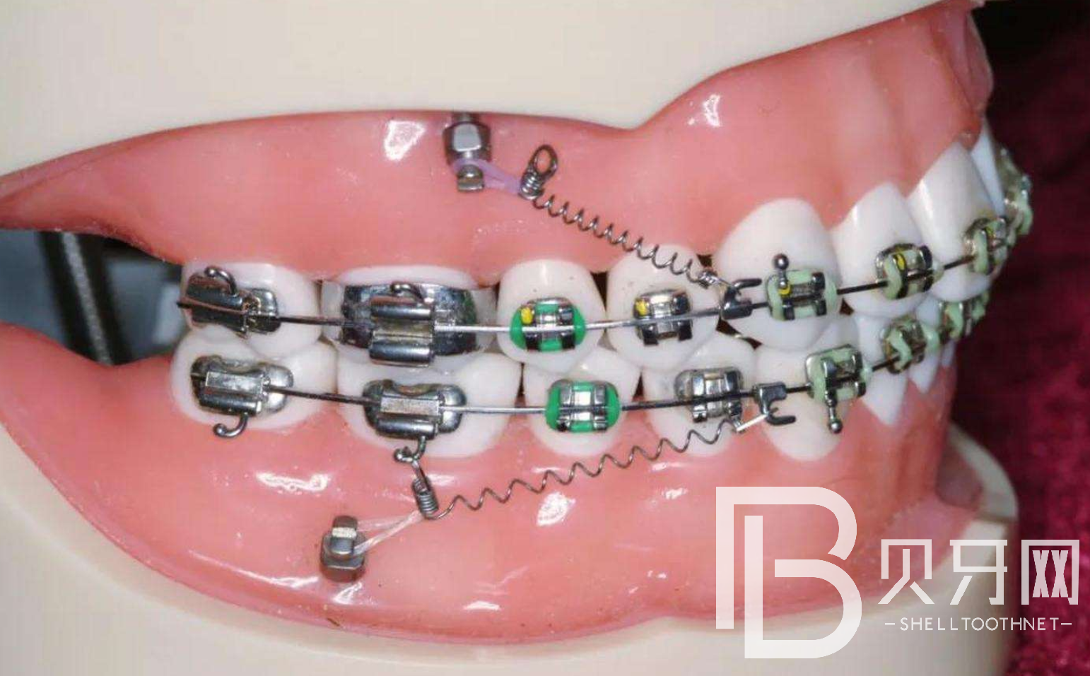 牙齒矯正多久才會有效果？牙齒矯正需要多長時(shí)間