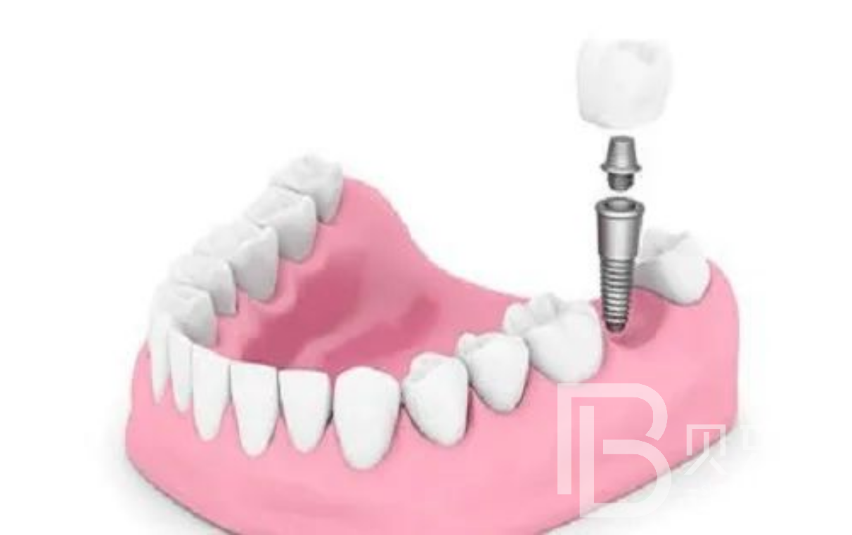 多顆牙缺失做種植牙需要多少錢？