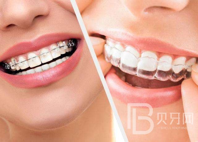 牙齒矯正有沒有年齡限制，牙齒矯正的黃金年齡
