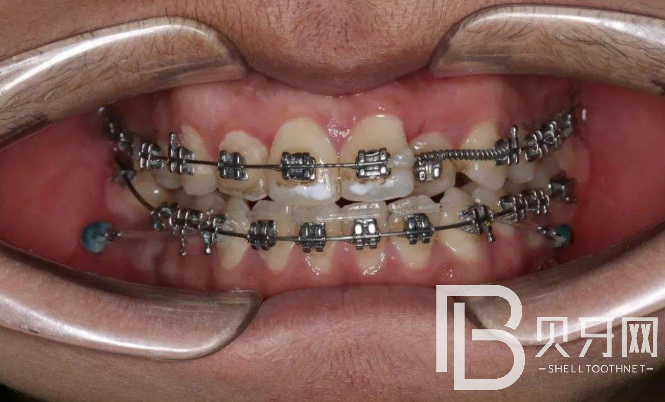 牙齒矯正之前，這幾件事一定要知道