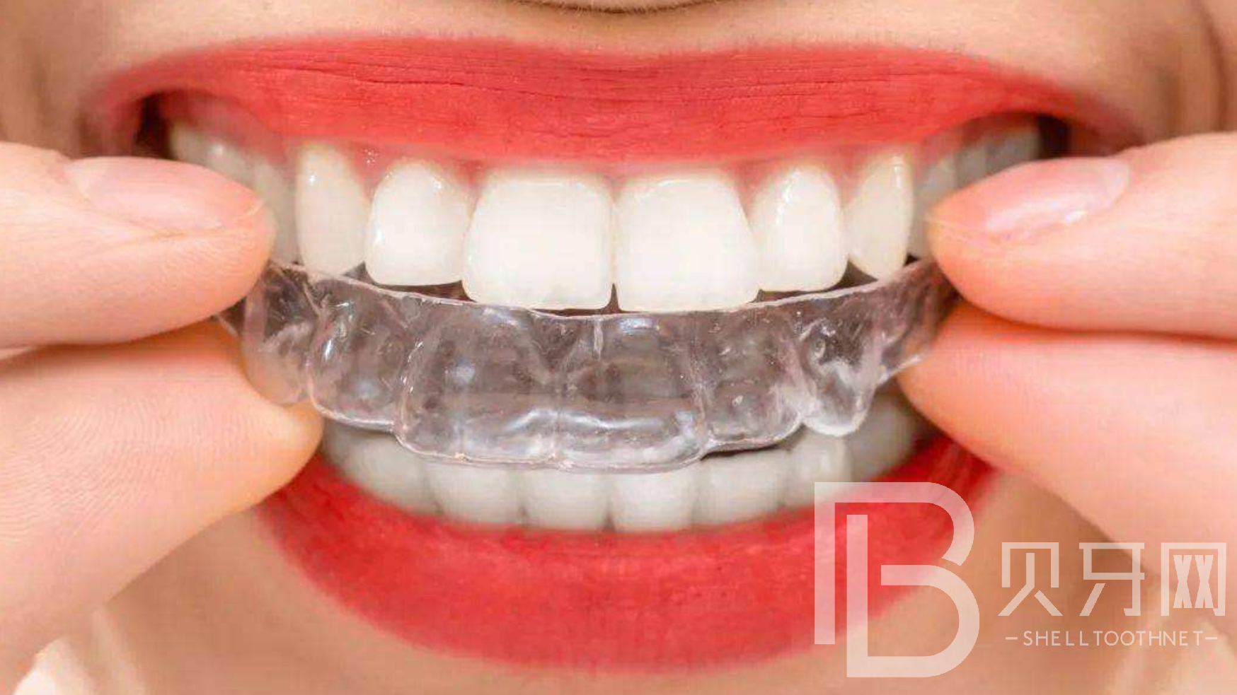 怎么讓牙齒變整齊又好看，三種常見方法了解一下