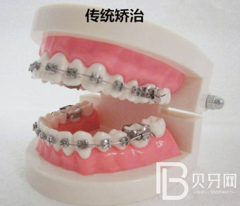 牙齒矯正需要多久，流程是什么樣的？