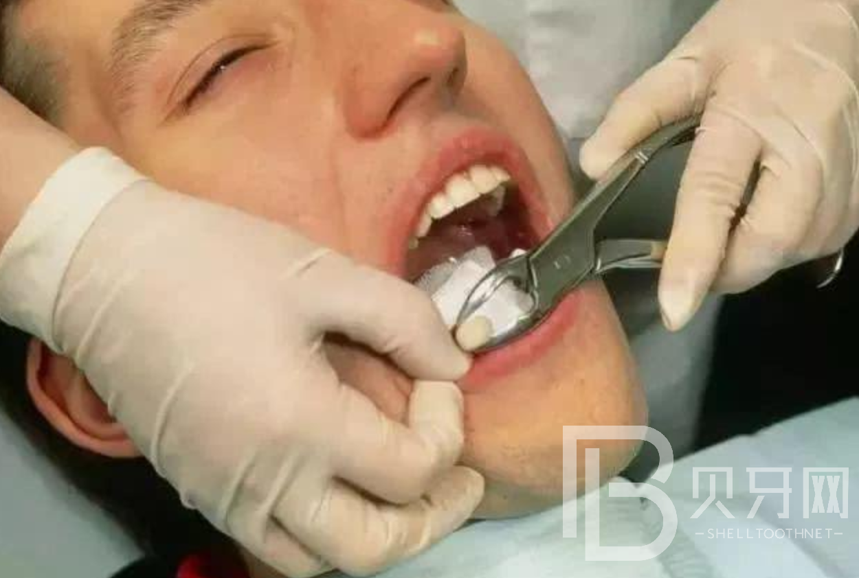 拔牙的注意事項(xiàng)有哪些，這幾個你一定要知道
