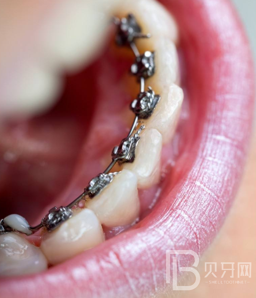 牙齒矯正后要注意什么？聽聽牙醫(yī)怎么說