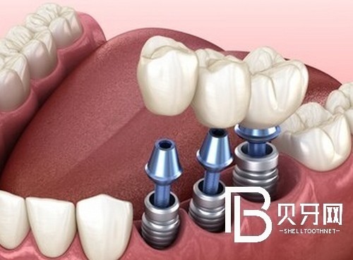 北京荷馬口腔看牙很貴嗎？醫(yī)院價格表告訴你實情！