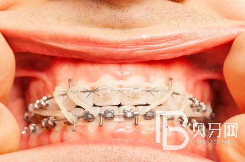 矯正牙齒能改變臉型嗎？北京美度口腔牙齒矯正多少錢