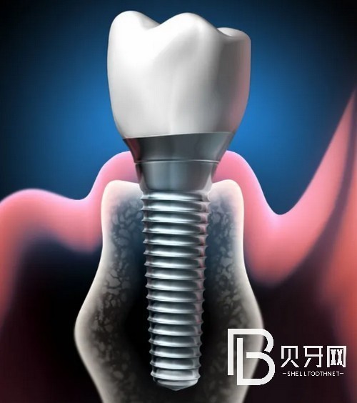 北京種植牙的價格表公布：看看在北京種牙哪里便宜！