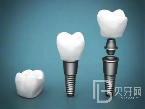 北京西爾口腔醫(yī)院種植牙價(jià)格表落地