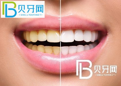 深圳蒙恩齒科怎么樣？深圳哪里牙科做種植牙？