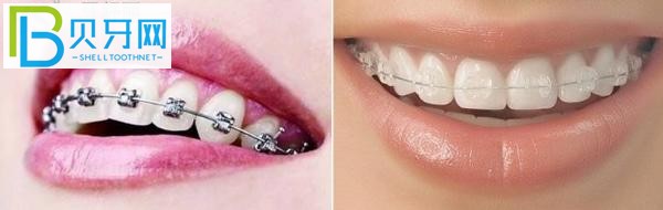 金屬矯正和半隱形矯正.jpg