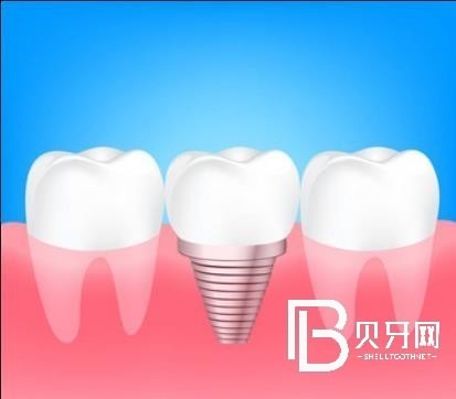 上海雅潔口腔怎么樣？種植牙多少錢？