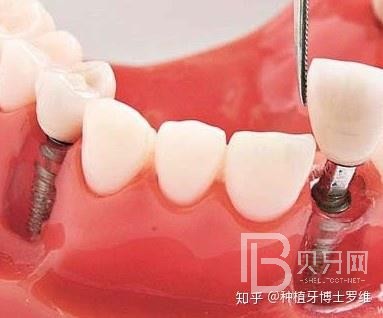 種植牙怎么樣？看看深圳諾德口腔怎么說！