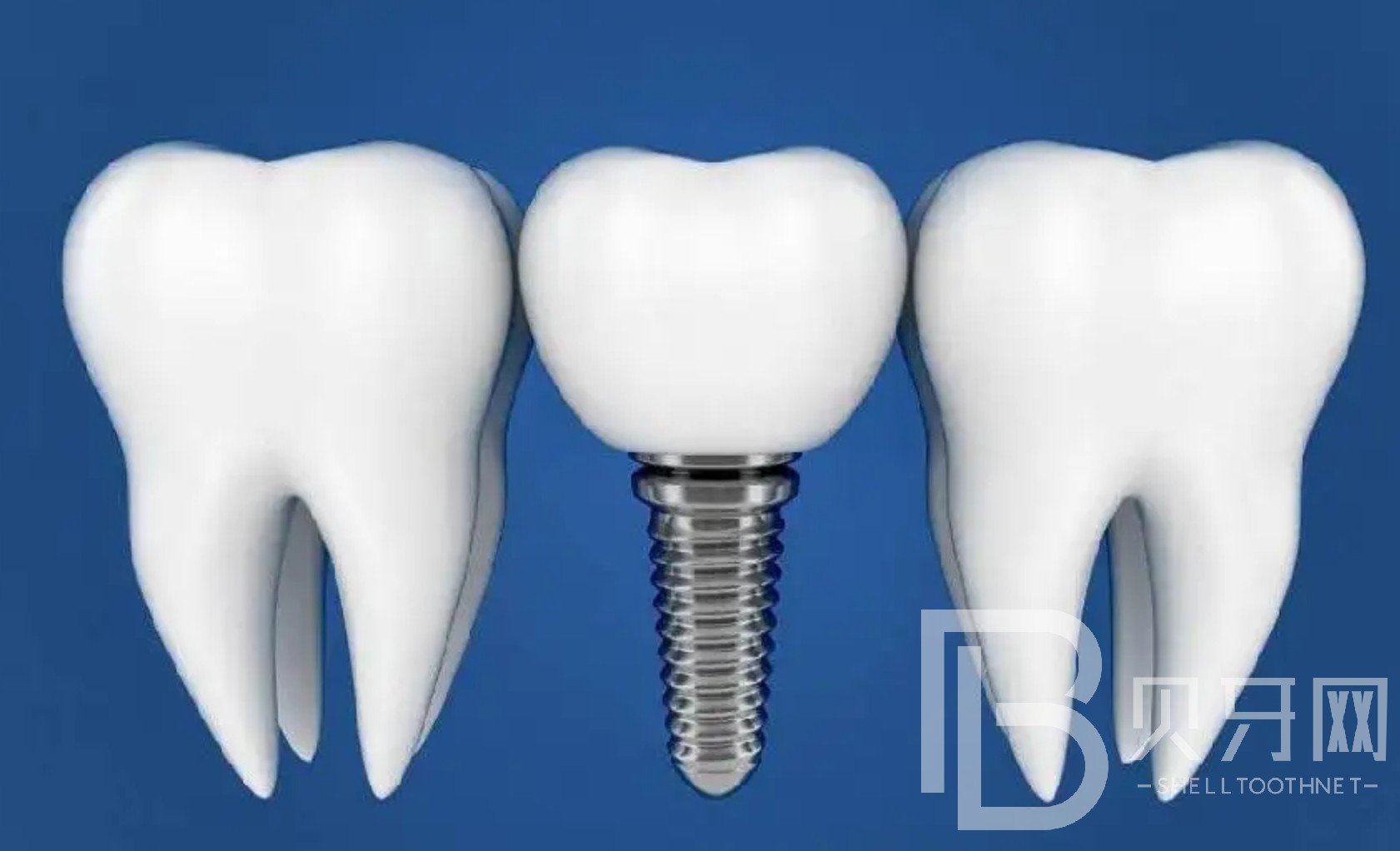半口種植牙大概要幾次完成？北京美冠塔口腔種植牙怎么樣？