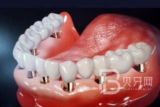 半口種植牙要種幾顆？北京維樂口腔正規(guī)嗎？