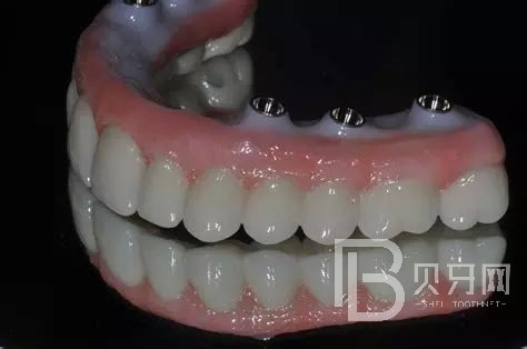 全口種植牙的利與弊都有哪些？北京拜博口腔正規(guī)嗎？