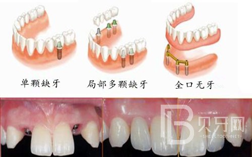 半口種植牙一般需要幾個(gè)階段？北京德貝口腔種植牙正規(guī)嗎？