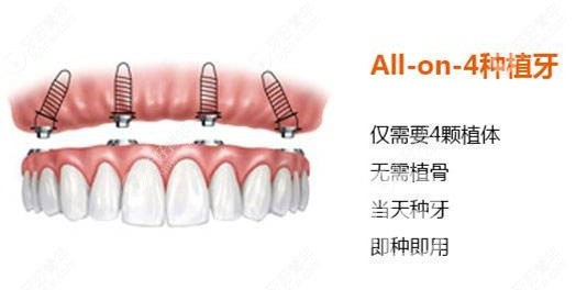 滿口種植牙需要種幾顆？北京佳美口腔正規(guī)嗎？