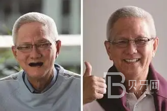 深圳拜爾口腔全口牙缺失種植牙