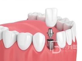 老年人適合種植牙么？北京薇琳口腔種植牙怎么樣？