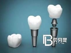北京種植牙齒價(jià)格多少？含北京種植牙價(jià)格表！